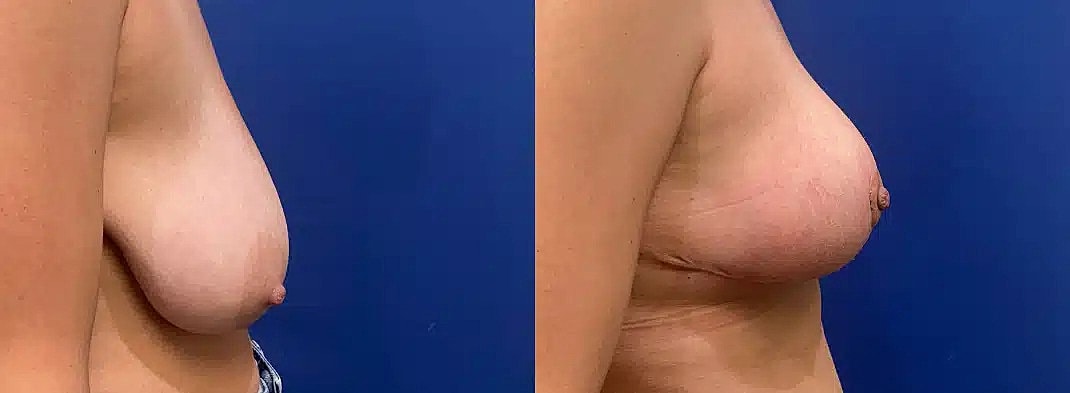 Breast Reduction Before & After