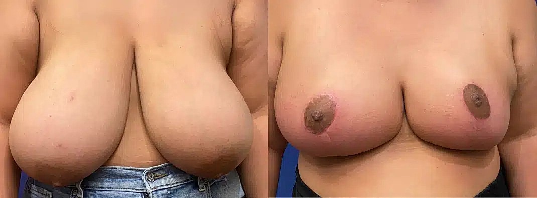 Breast Reduction Before & After