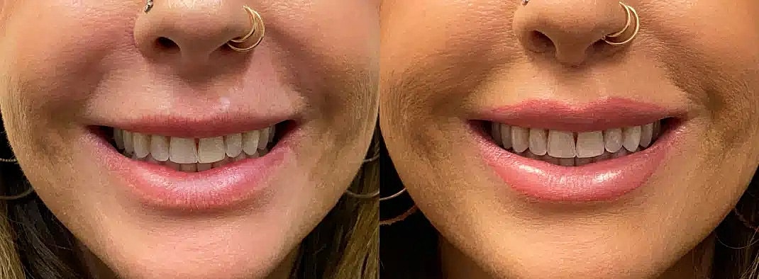 Aumento De Labios Before & After