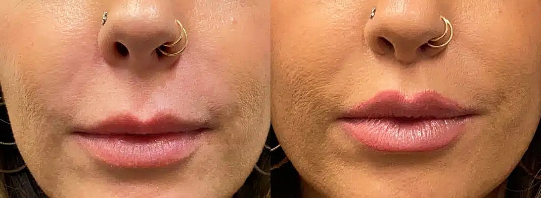 Aumento De Labios Before & After