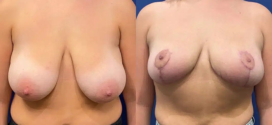 Reduccion De Senos Before & After