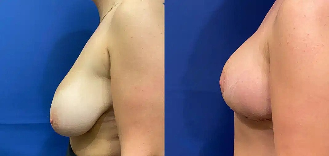 Reduccion De Senos Before & After