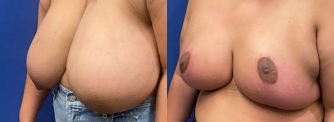Reduccion De Senos Before & After