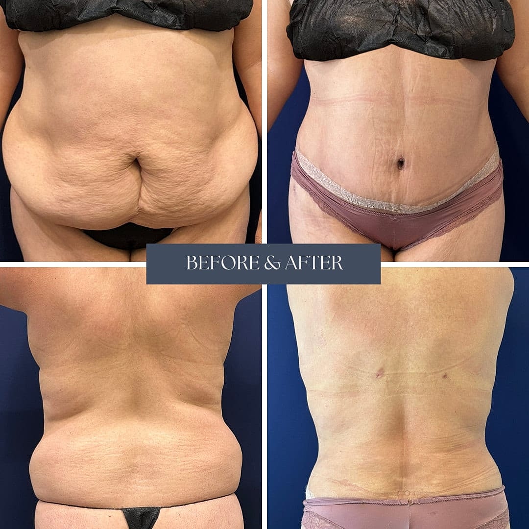 Abdominoplastia Before & After