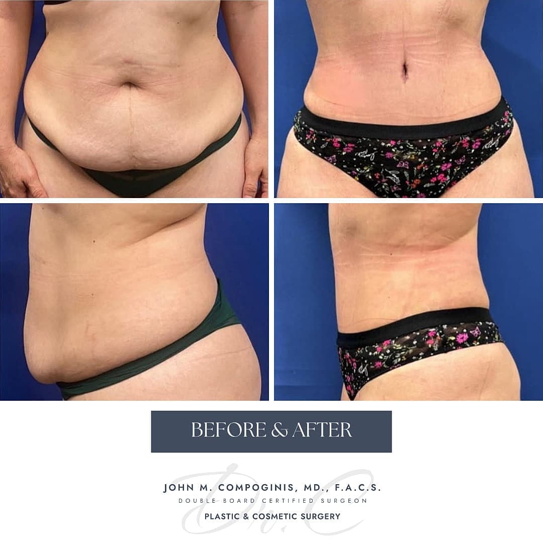 Abdominoplastia Before & After