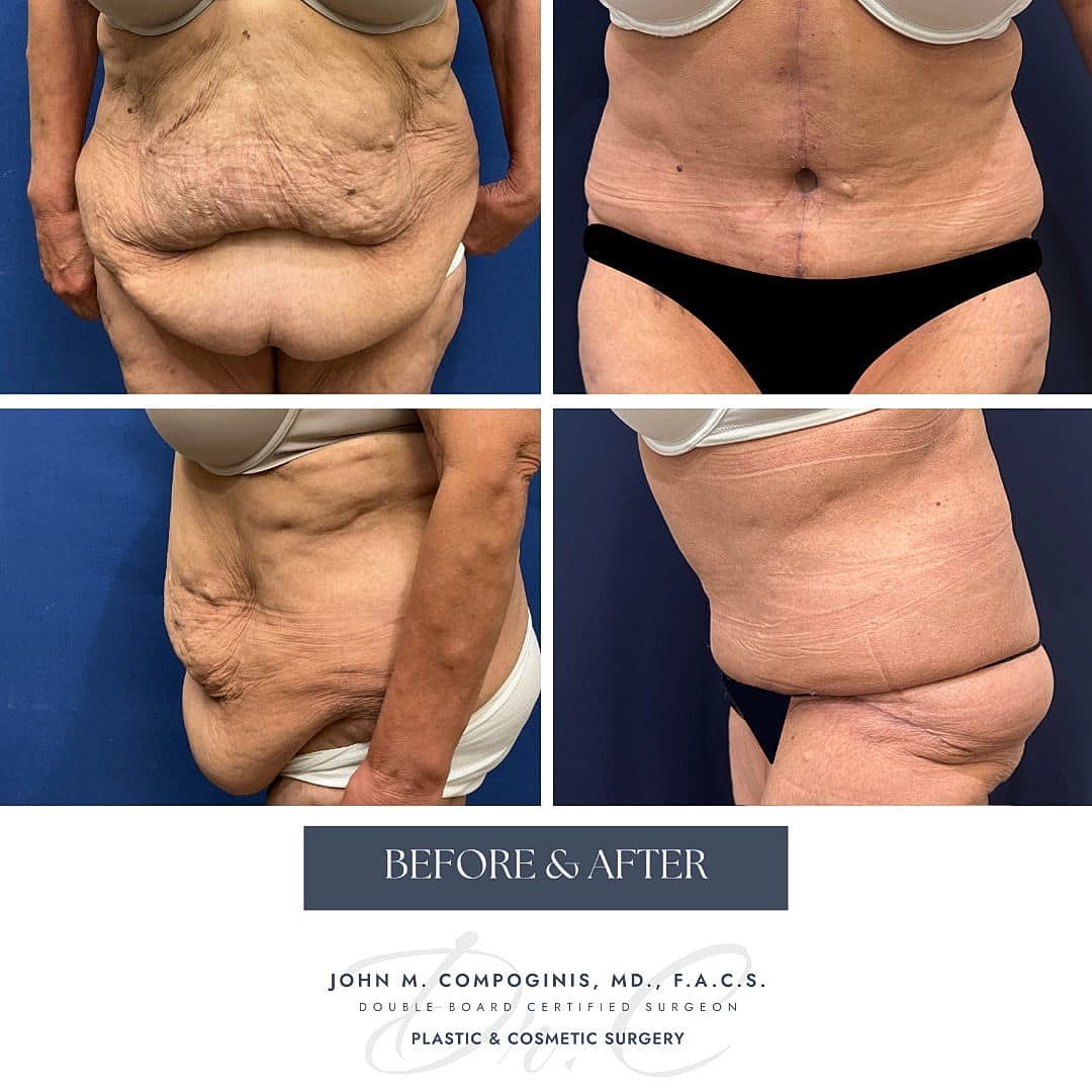 Abdominoplastia Before & After