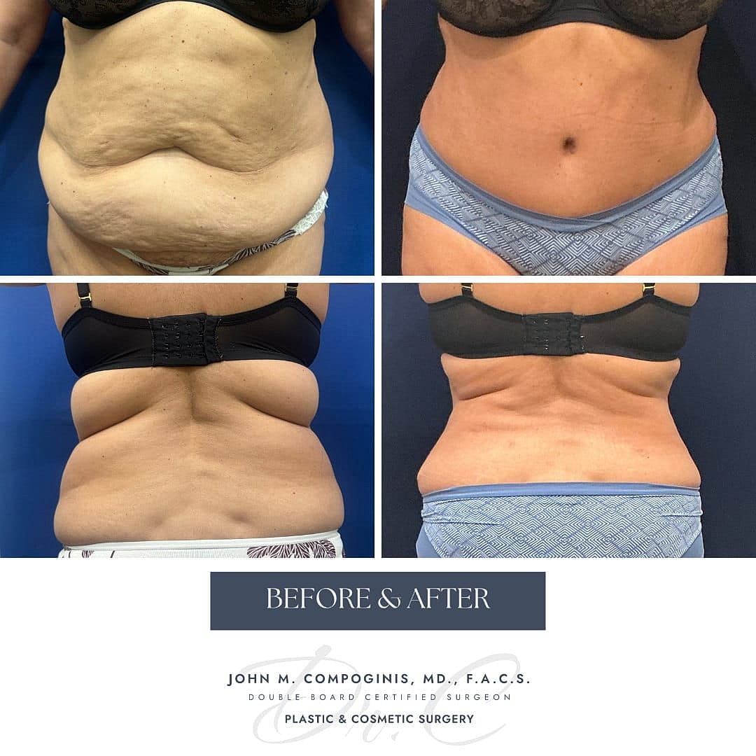 Abdominoplastia Before & After