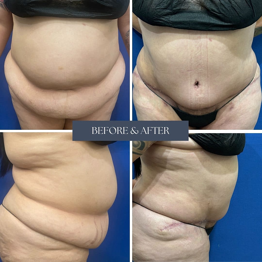 Abdominoplastia Before & After