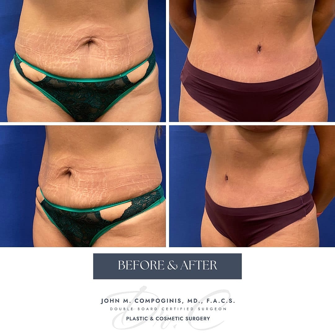 Abdominoplastia Before & After