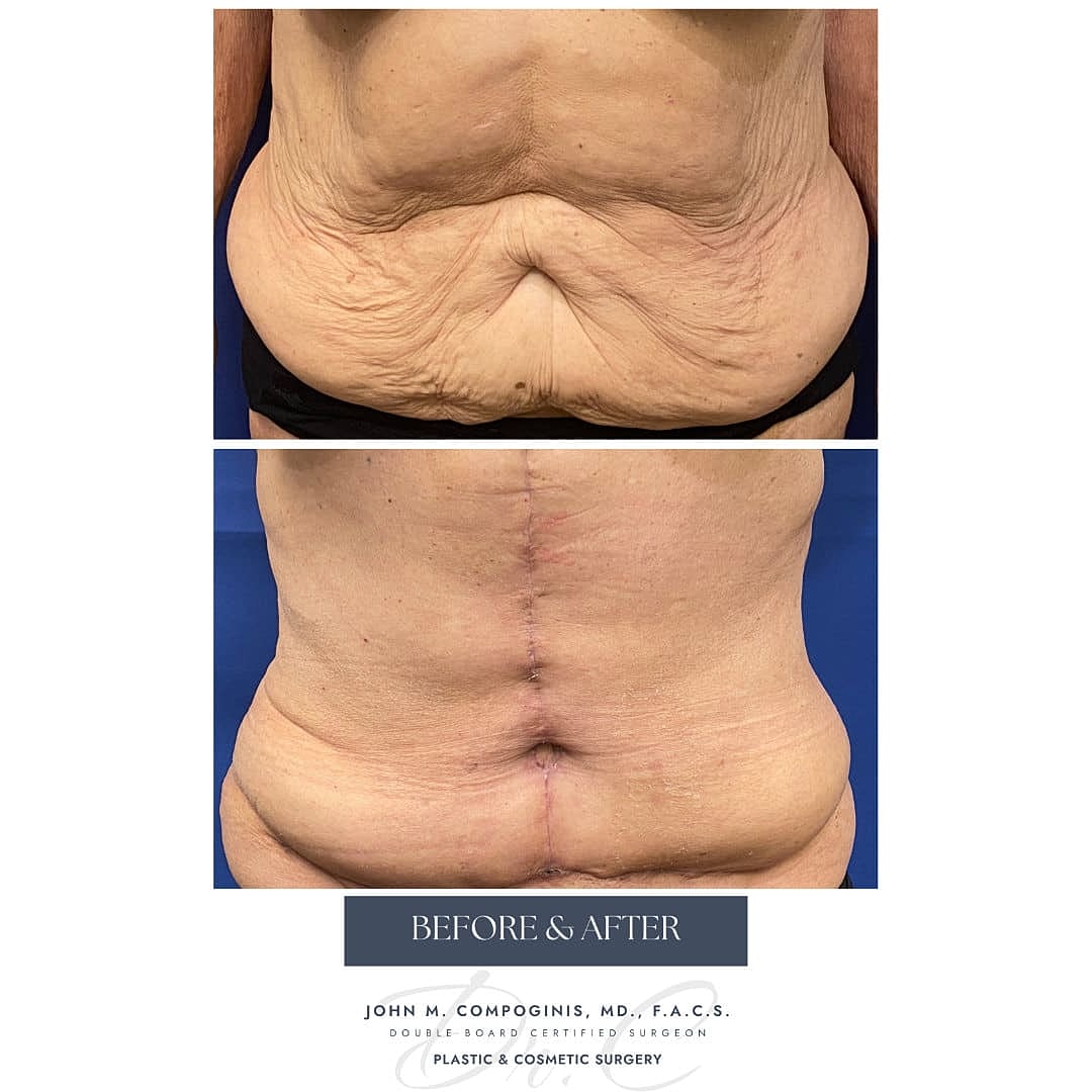 Abdominoplastia Before & After