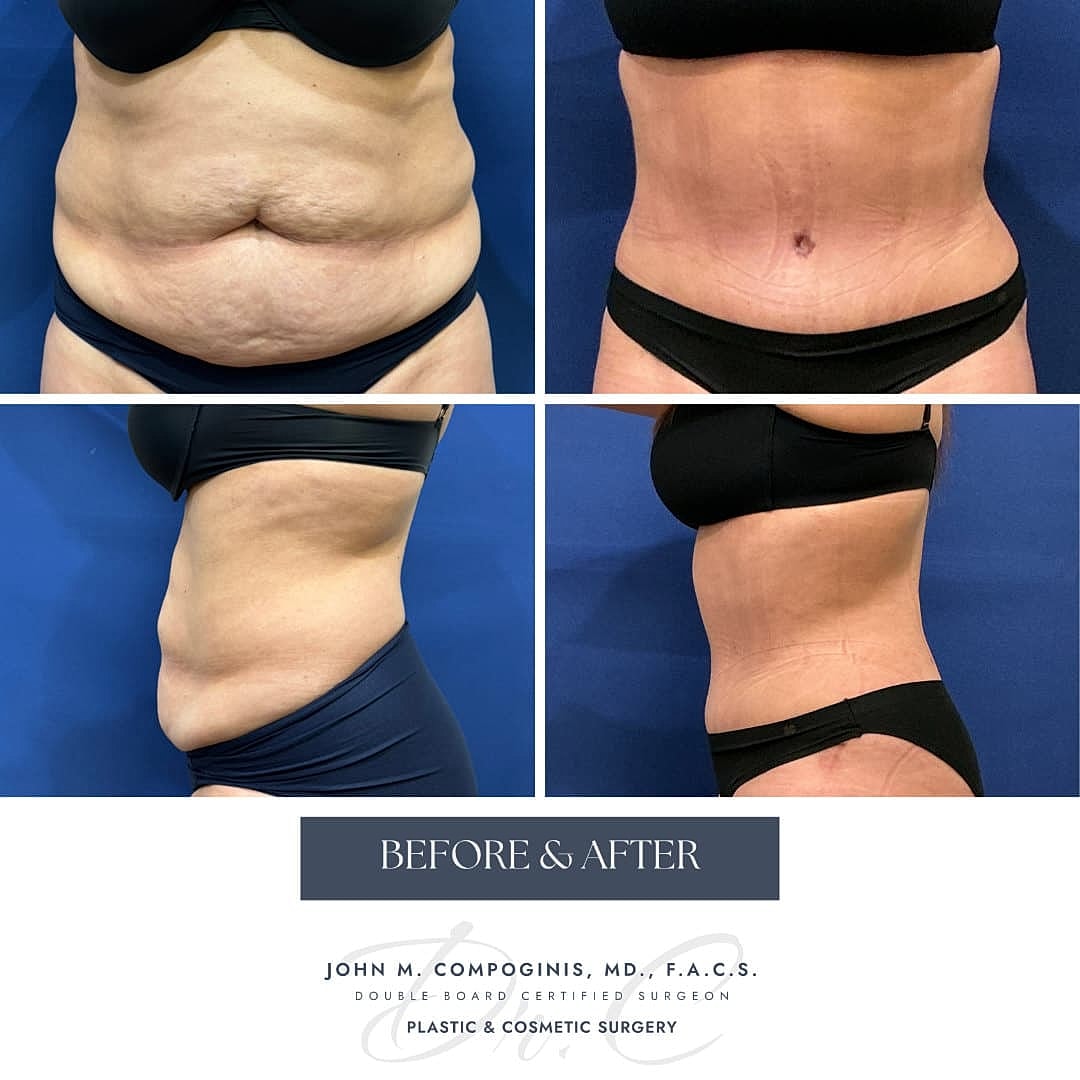Abdominoplastia Before & After