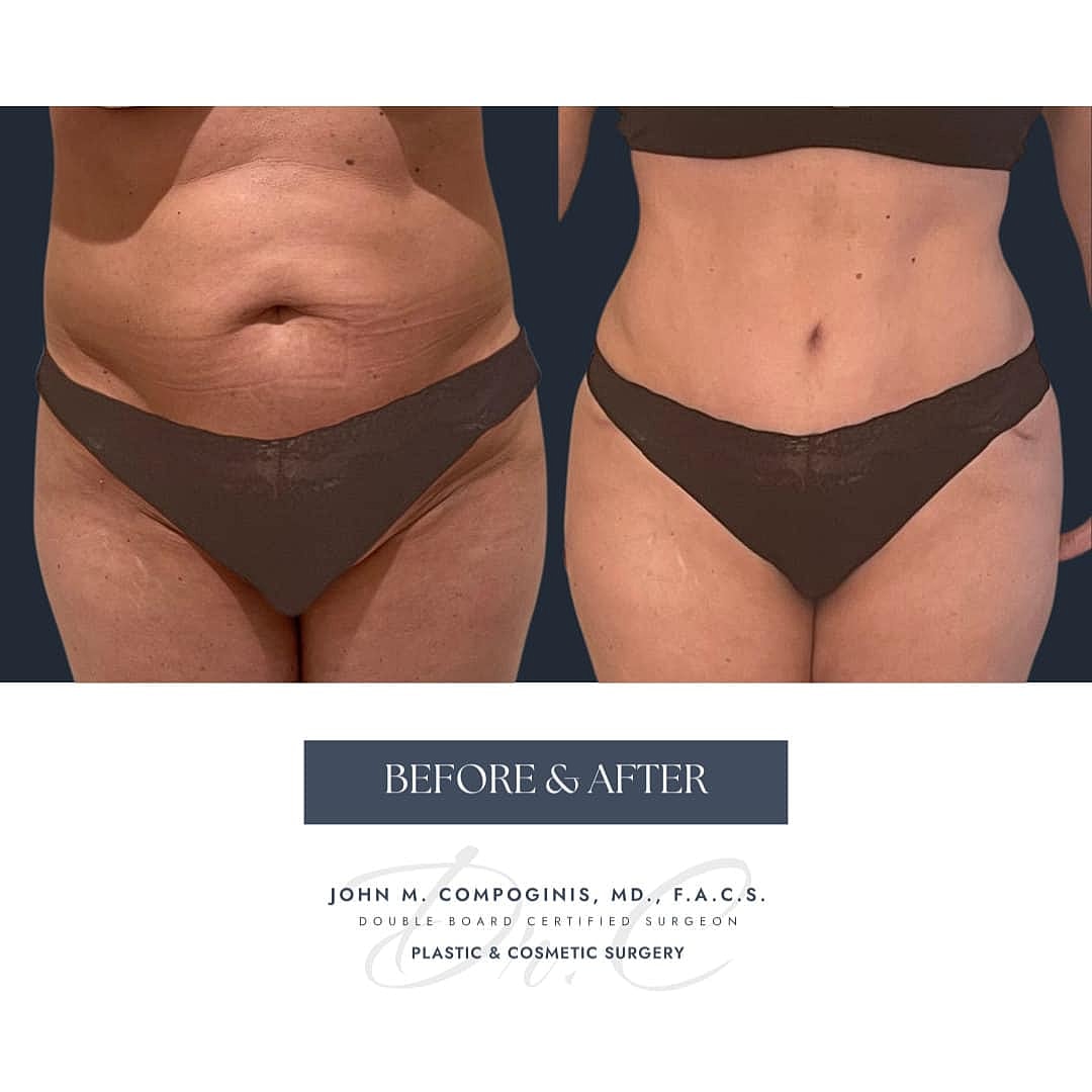 Abdominoplastia Before & After