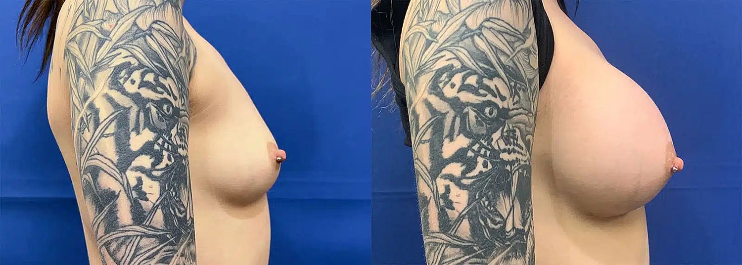 Breast Augmentation Before & After