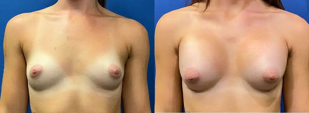 Breast Augmentation Before & After