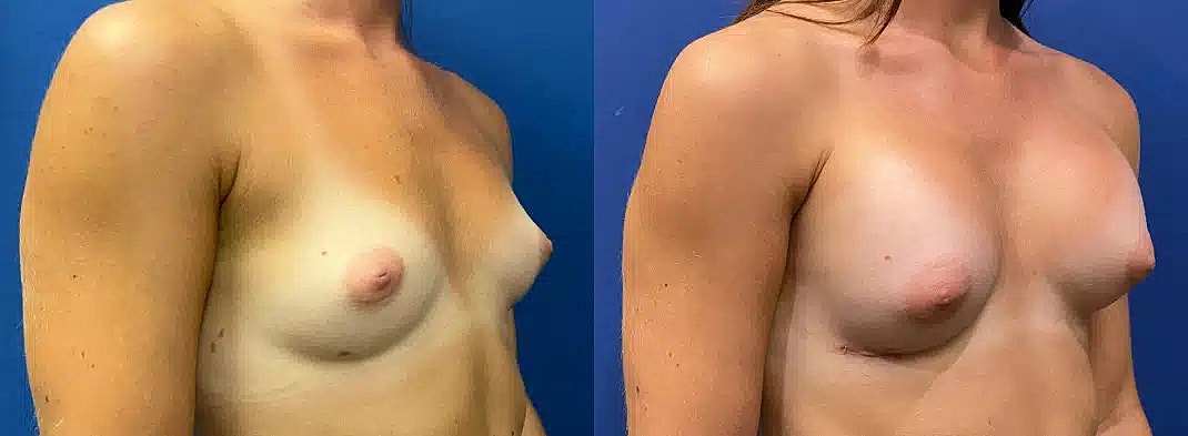 Breast Augmentation Before & After