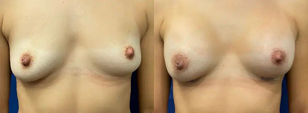 Breast Augmentation Before & After