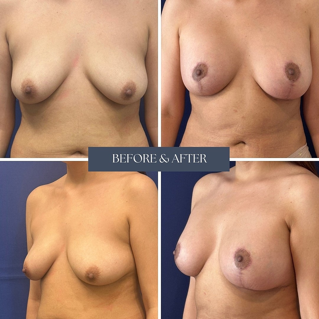 Breast augmentation before and after comparison.