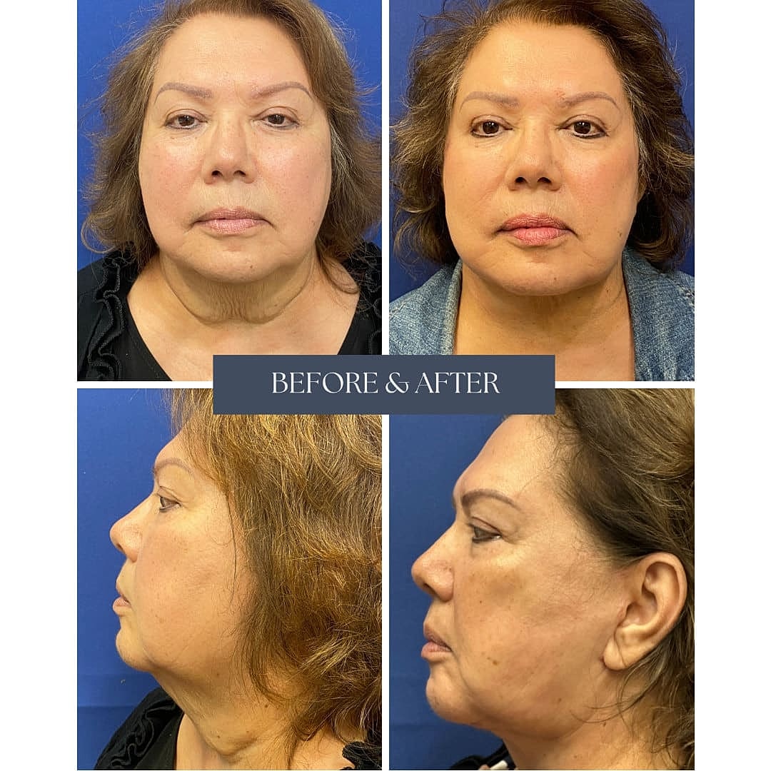 Facelift Before & After