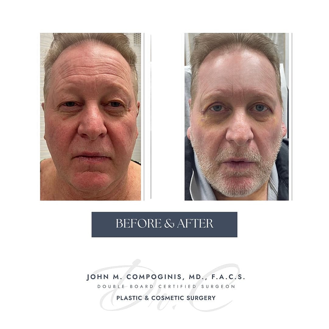 Facelift Before & After