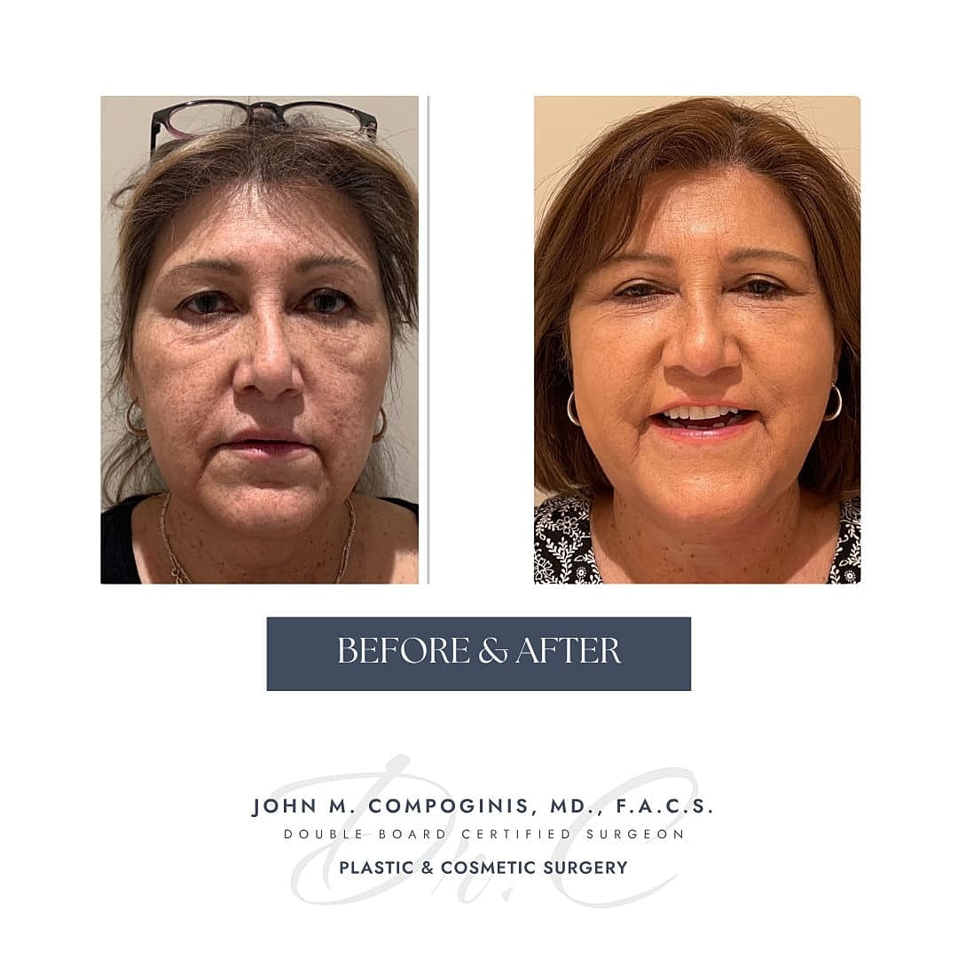 Facelift Before & After