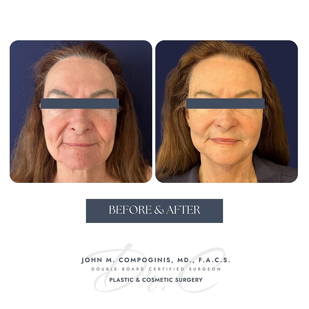 Before and after cosmetic surgery transformation.
