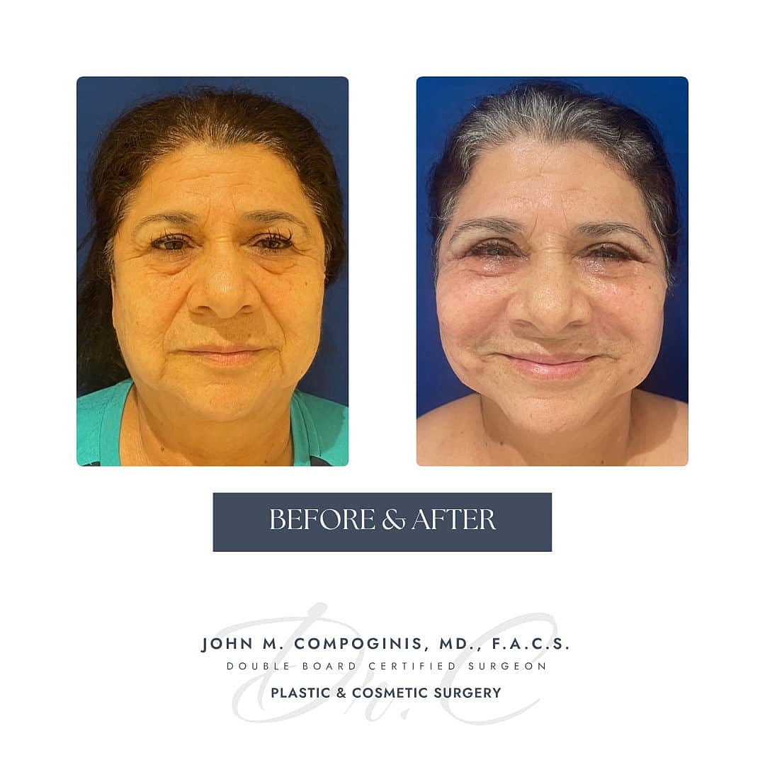 Rejuvenecimiento Facial Before & After