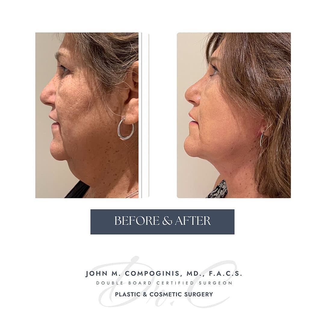 Rejuvenecimiento Facial Before & After