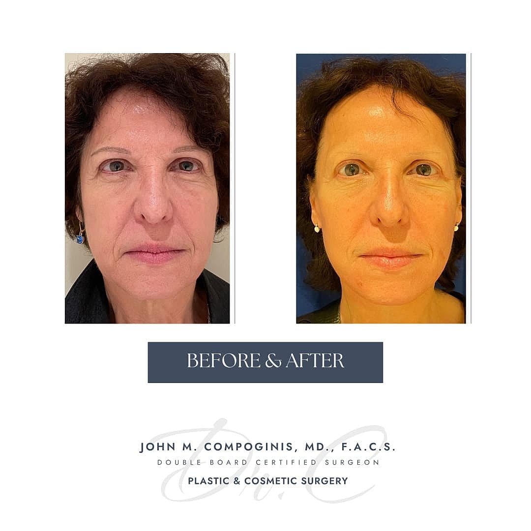 Rejuvenecimiento Facial Before & After
