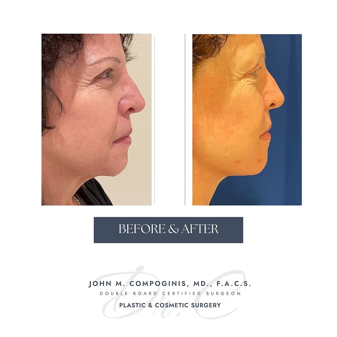 Rejuvenecimiento Facial Before & After