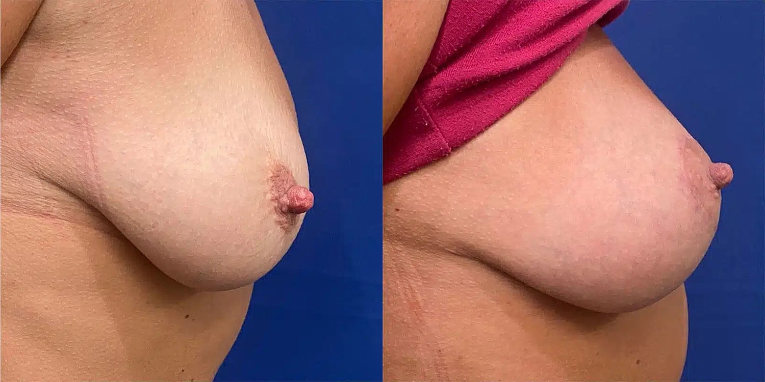 Breast Lift Before & After