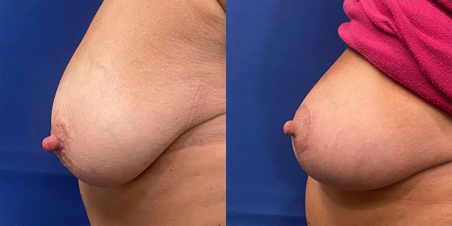 Breast Lift Before & After