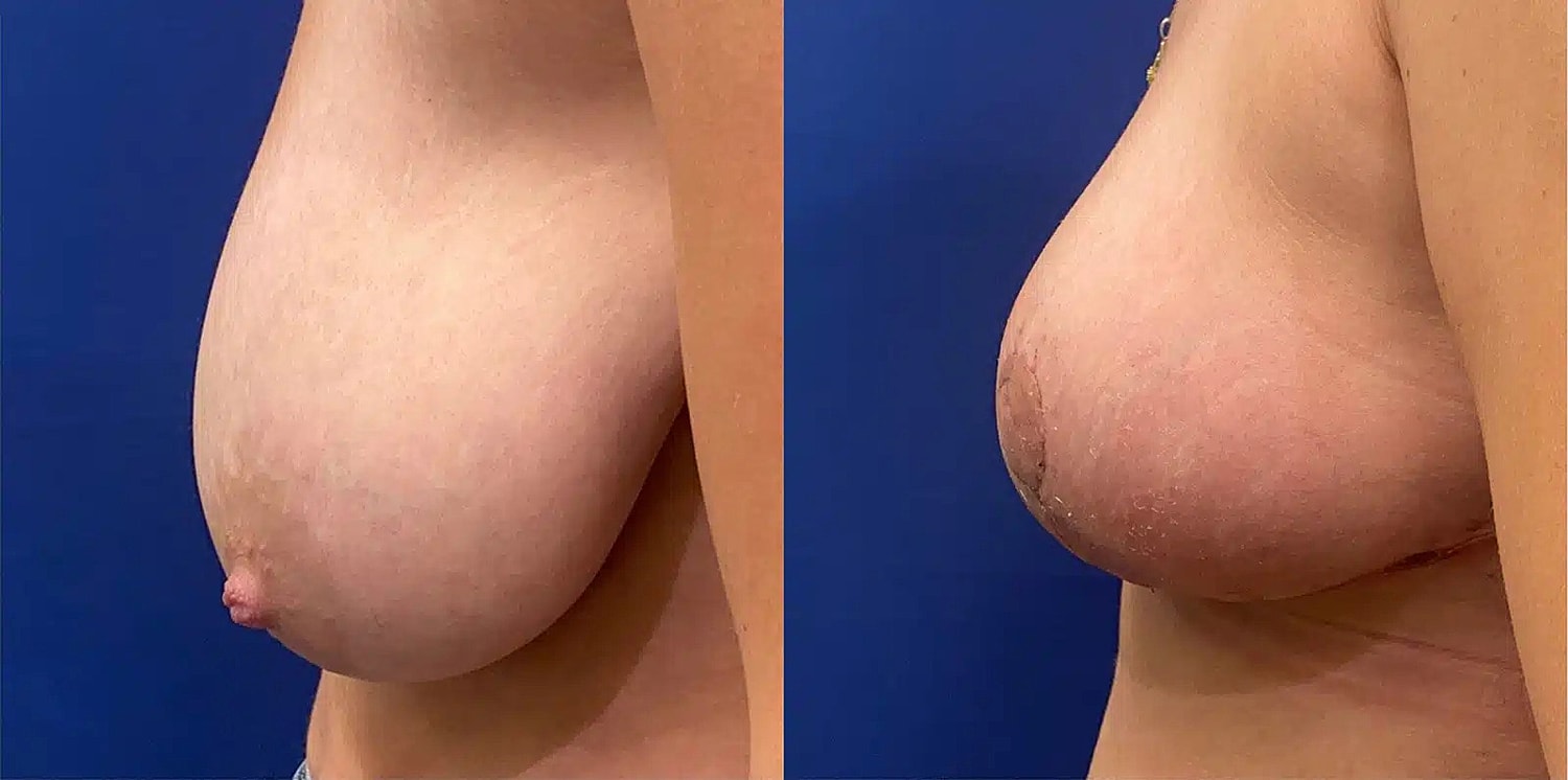 Breast Lift Before & After