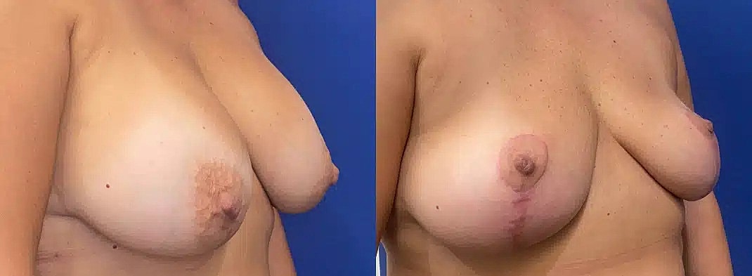 Breast Lift Before & After