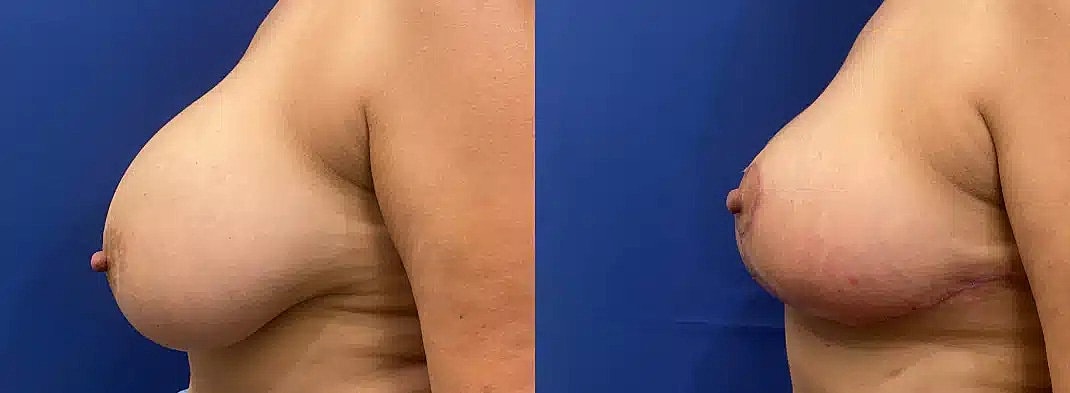 Breast Lift Before & After