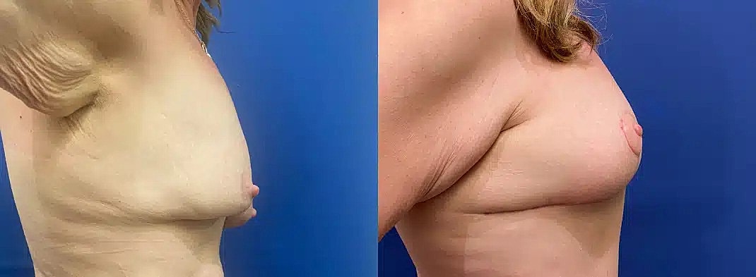 Breast Lift Before & After