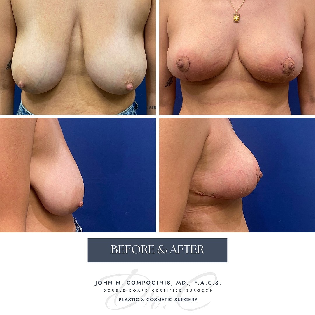 Breast augmentation before and after photos.