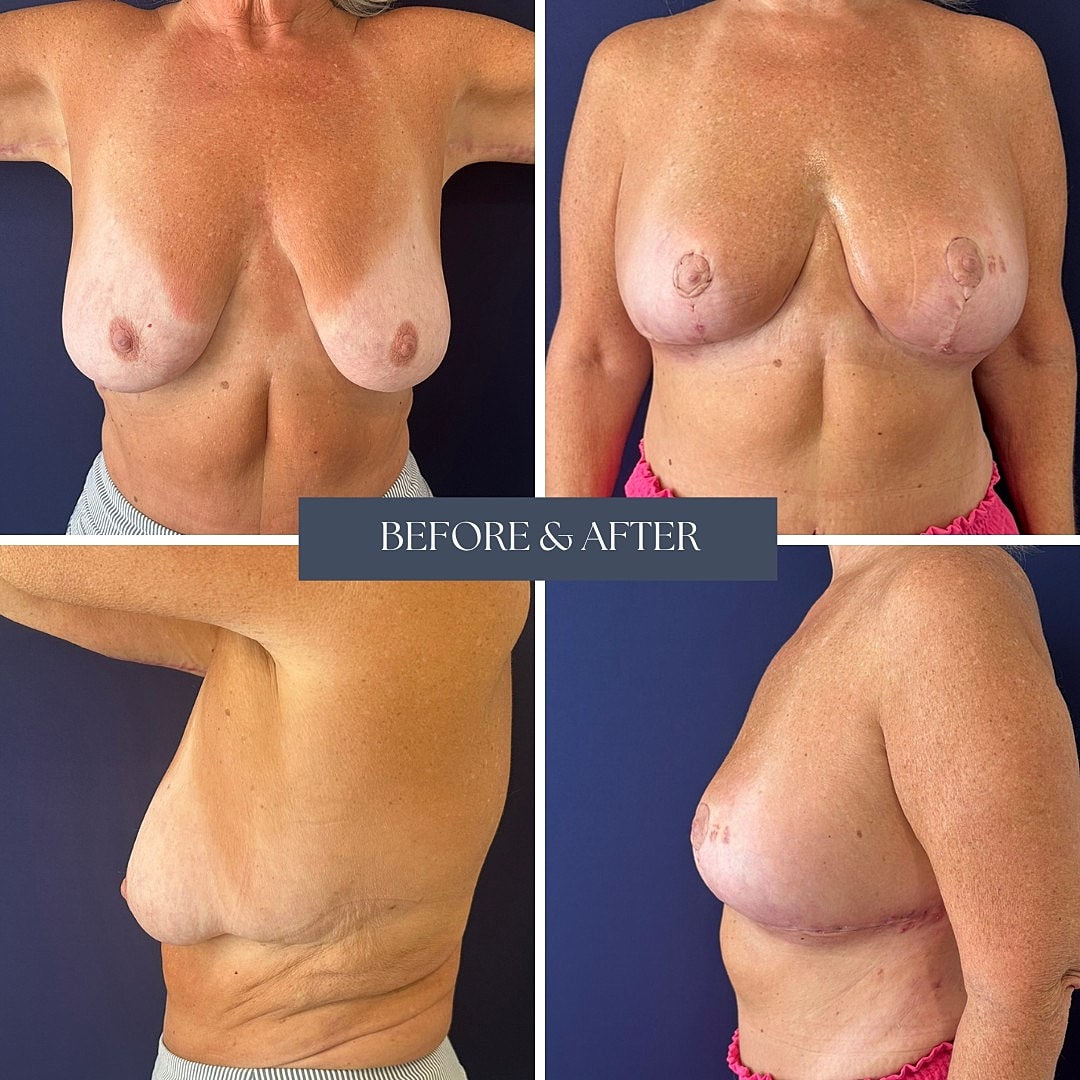 Breast augmentation before and after photos.