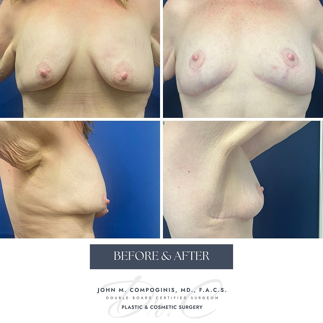 Breast surgery before and after photos.