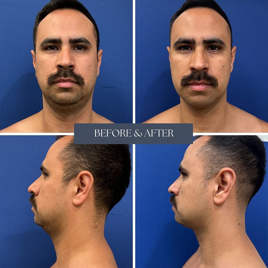Liposuccion Before & After