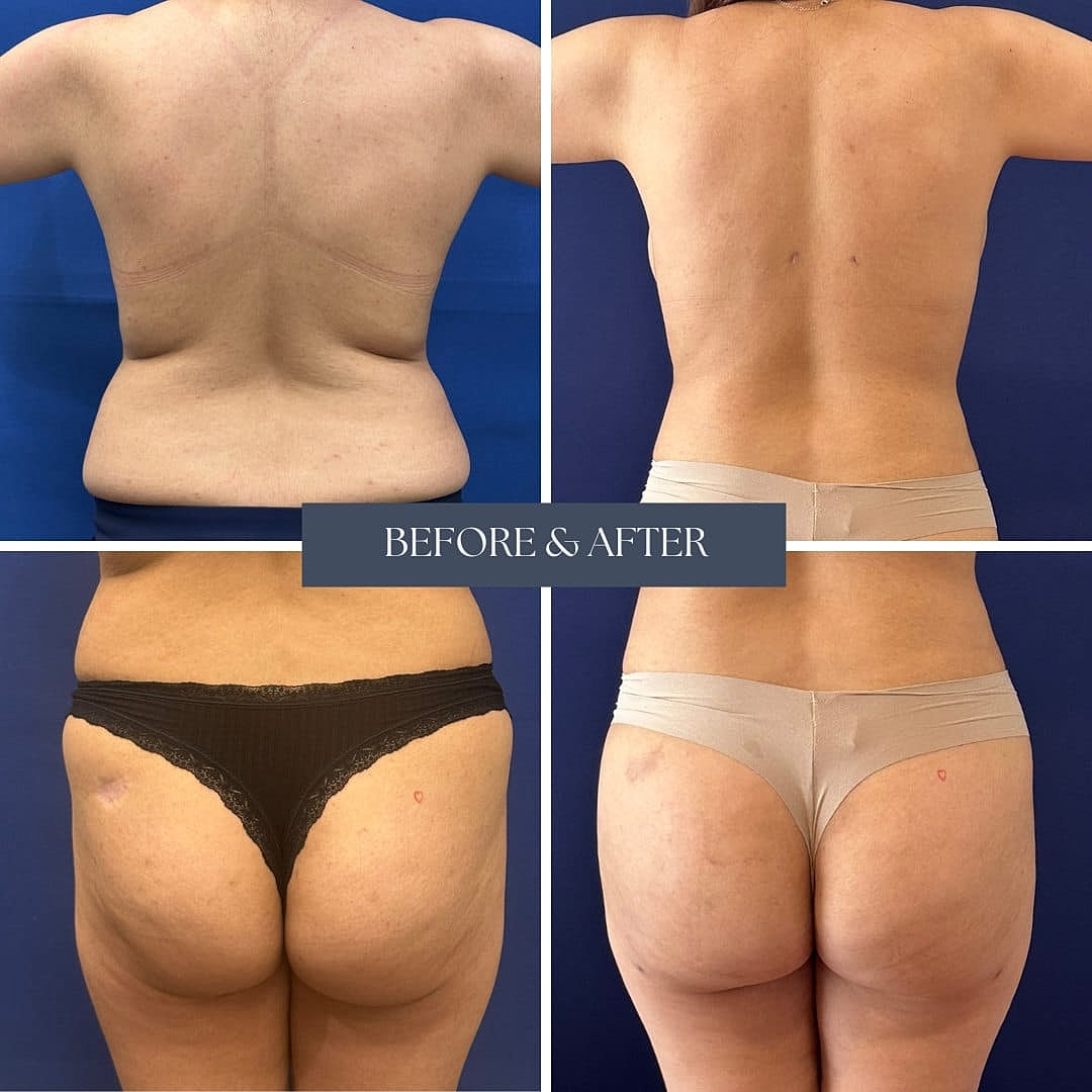 Liposuccion Before & After