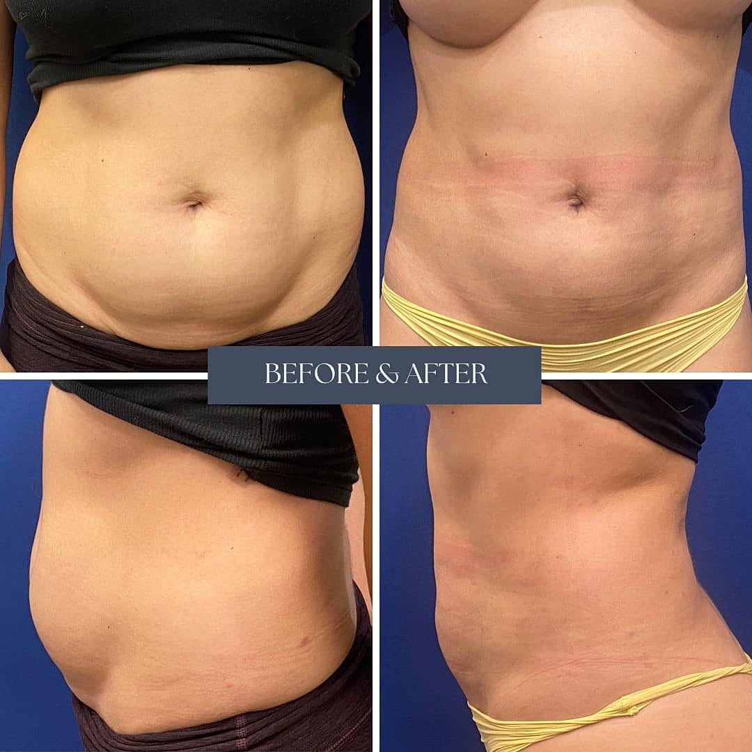Liposuccion Before & After