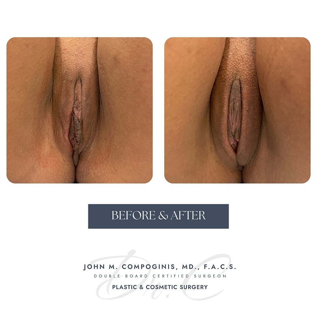 Labioplastia Before & After