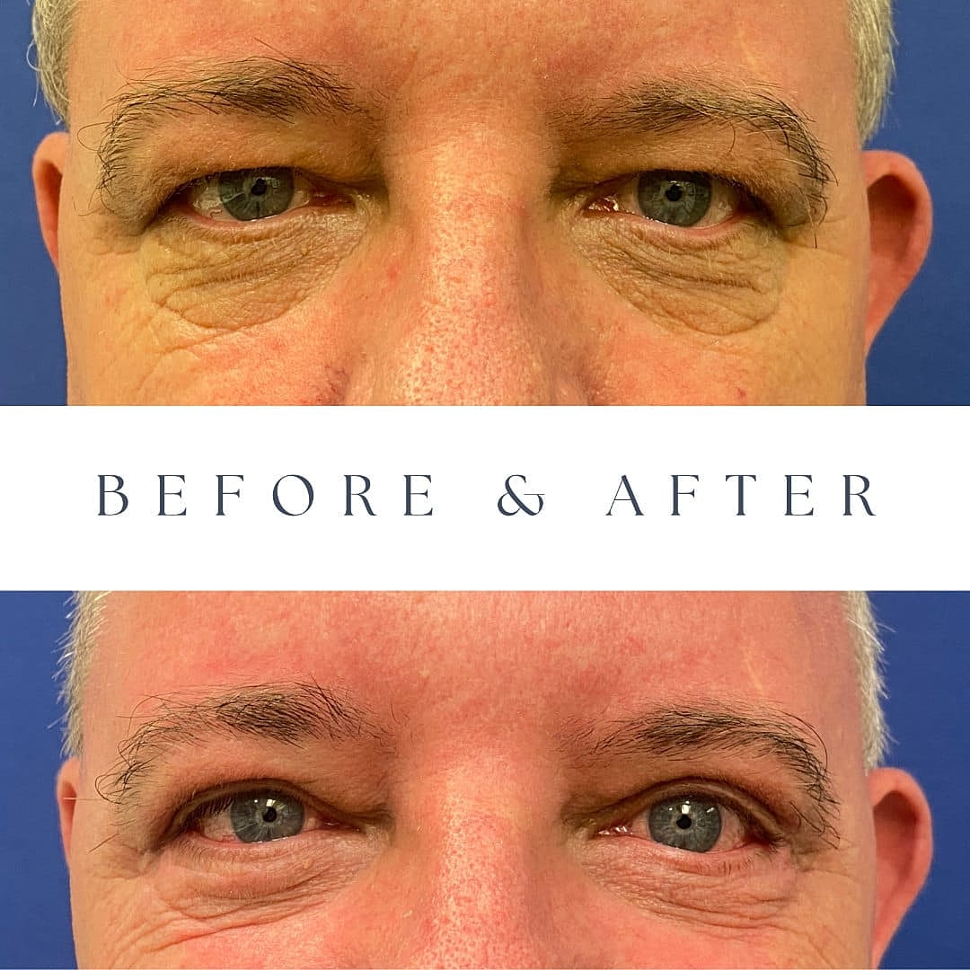 Blepharoplasty Before & After