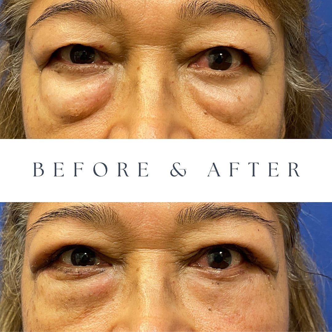 Blepharoplasty Before & After