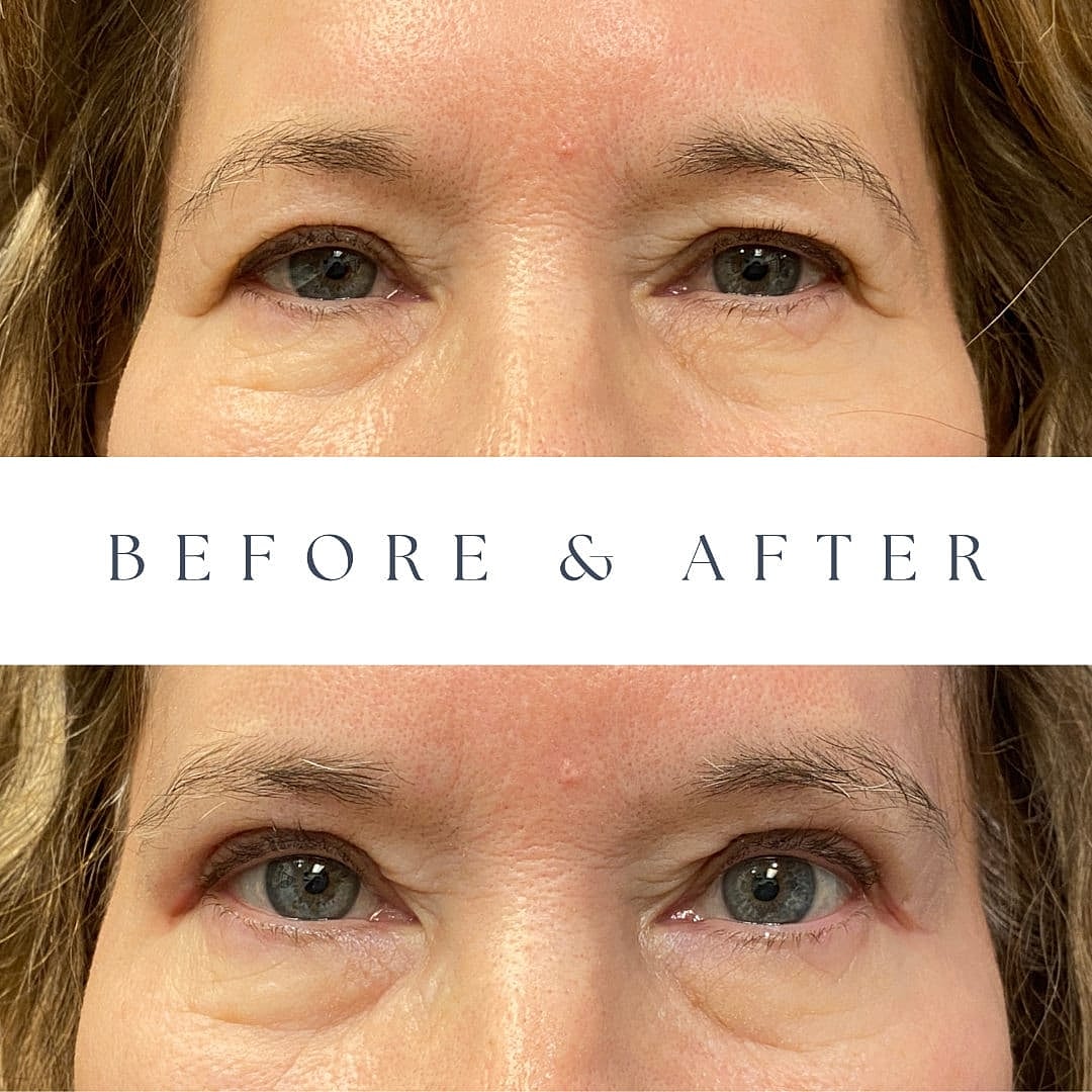 Blepharoplasty Before & After