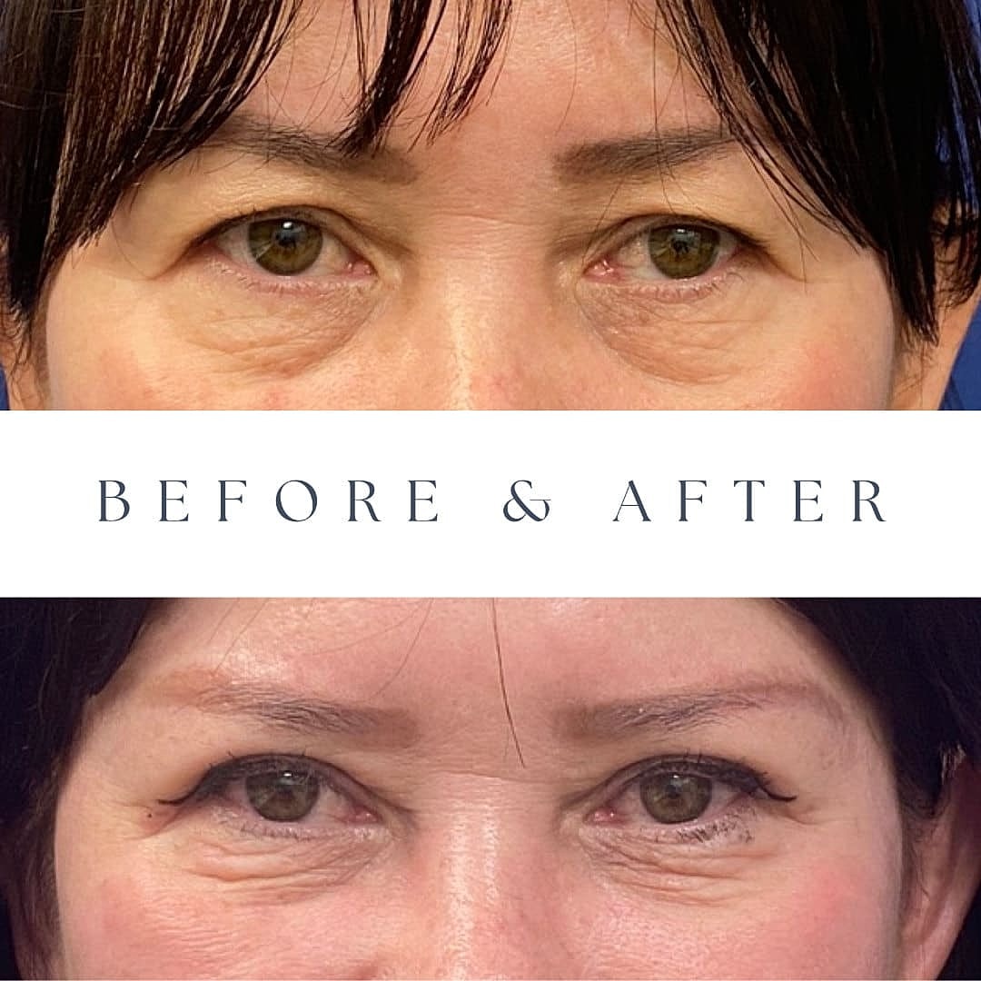 Blepharoplasty Before & After