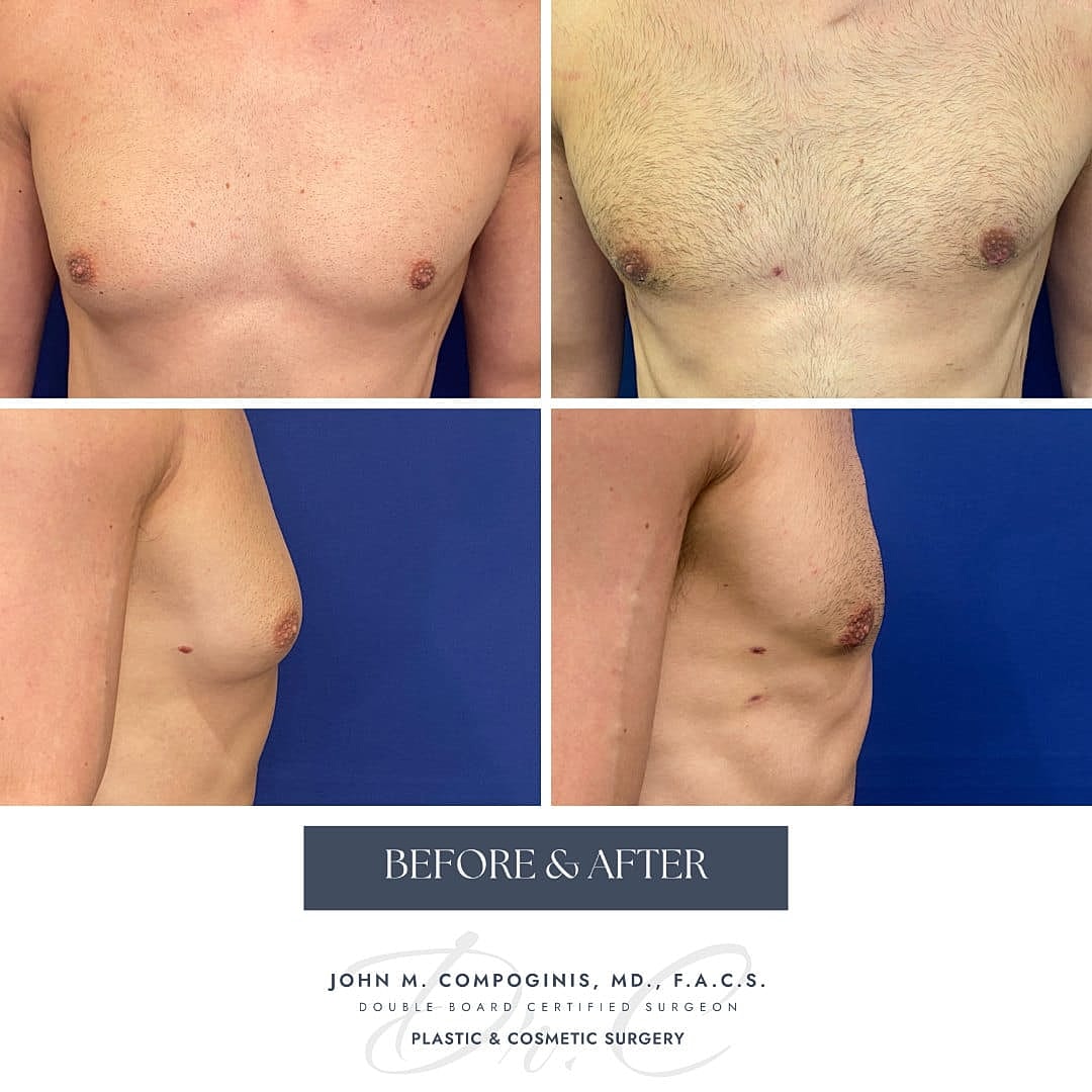 Gynecomastia Before & After