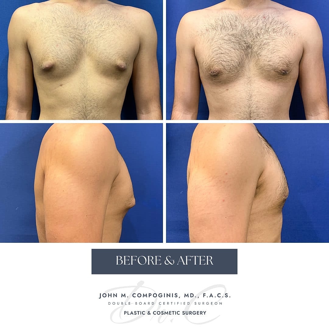 Gynecomastia Before & After