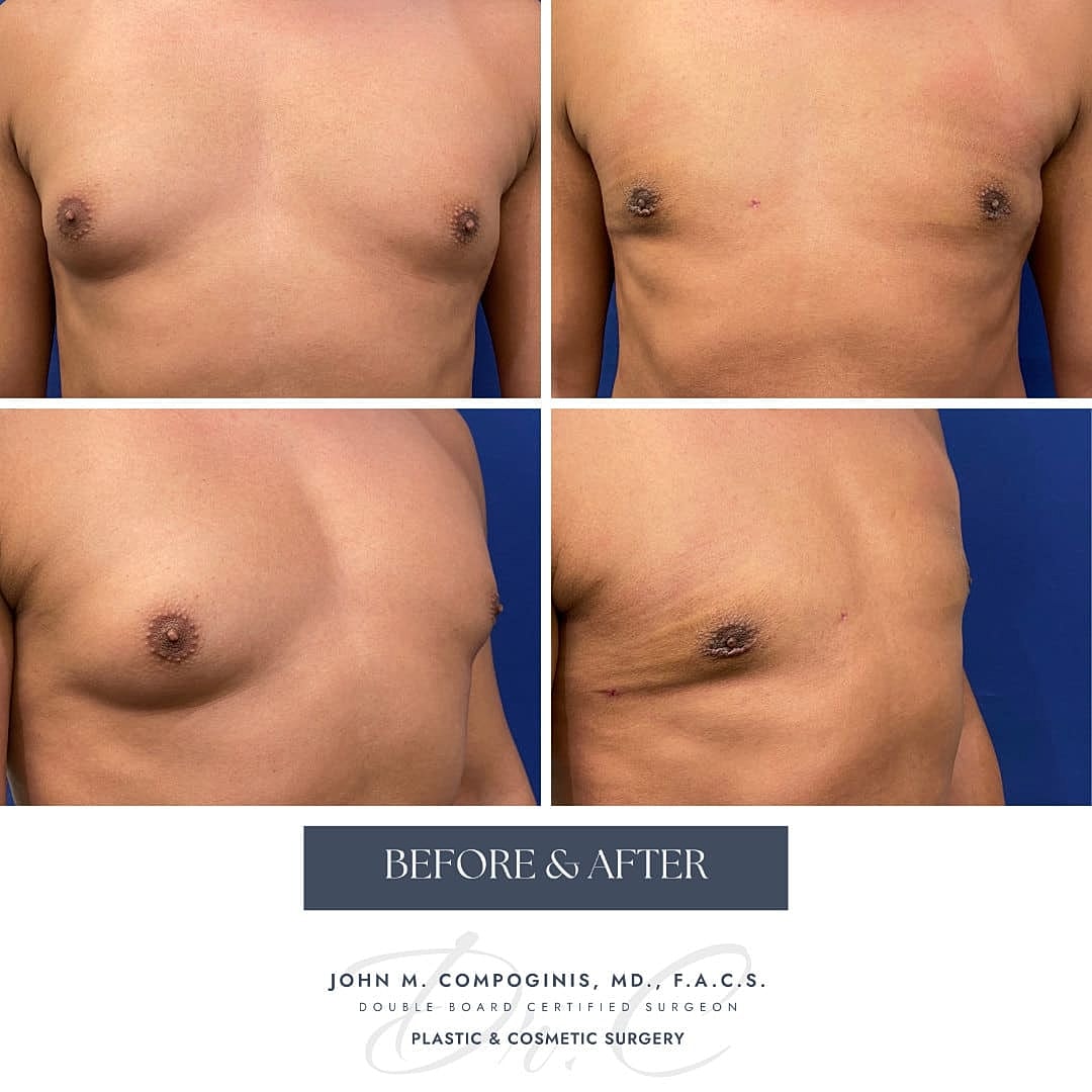 Gynecomastia Before & After