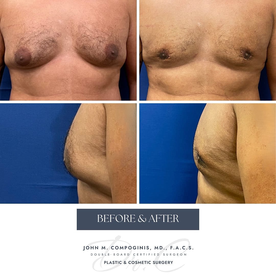 Gynecomastia Before & After